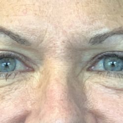 Quad Blepharoplasty Before & After Patient #3620