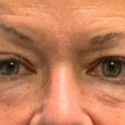 Quad Blepharoplasty Before & After Patient #3620
