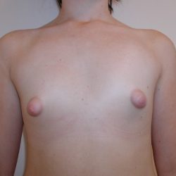 Breast Augmentation Before & After Patient #3479