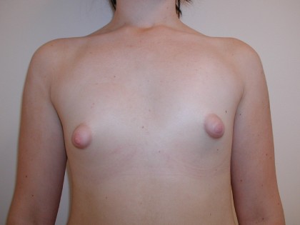 Breast Augmentation Before & After Patient #3479