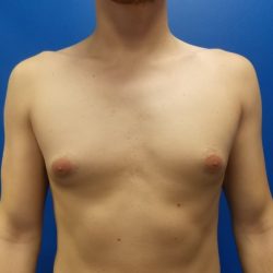 Gynecomastia Before & After Patient #2065