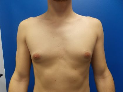 Gynecomastia Before & After Patient #2065