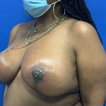 Local Flap Breast Reconstruction Before & After Patient #3685