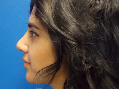 Rhinoplasty Before & After Patient #3704
