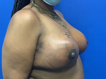 Local Flap Breast Reconstruction Before & After Patient #3685