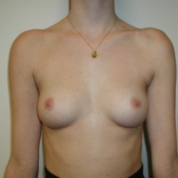 Breast Augmentation Before & After Patient #3715