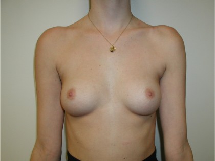 Breast Augmentation Before & After Patient #3715