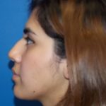 Rhinoplasty Before & After Patient #3704
