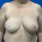 TRAM Flap Breast Reconstruction Before & After Patient #3823
