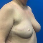 TRAM Flap Breast Reconstruction Before & After Patient #3823