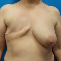 TRAM Flap Breast Reconstruction Before & After Patient #3823