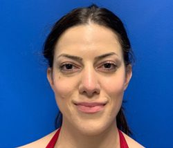 Rhinoplasty Before & After Patient #4095