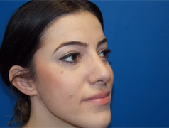Rhinoplasty Before & After Patient #4095