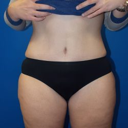 Body Contouring Before & After Patient #3891