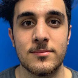 Rhinoplasty Before & After Patient #4084