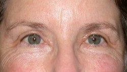 Upper Blepharoplasty Before & After Patient #3880