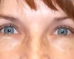 Upper Blepharoplasty Before & After Patient #3900