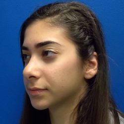 Rhinoplasty Before & After Patient #3840