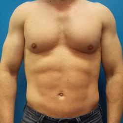 Liposuction Before & After Patient #3914