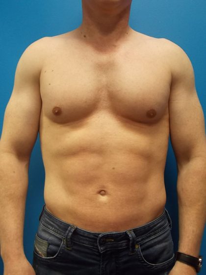 Liposuction Before & After Patient #3914