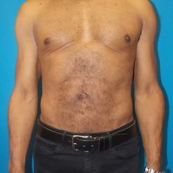 Liposuction Before & After Patient #3933