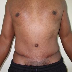 Tummy Tuck Before & After Patient #3984