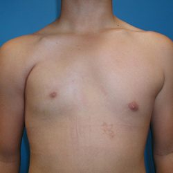 Poland Syndrome Before & After Patient #4018