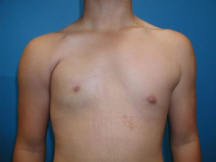 Poland Syndrome Before & After Patient #4018