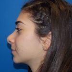 Rhinoplasty Before & After Patient #3840
