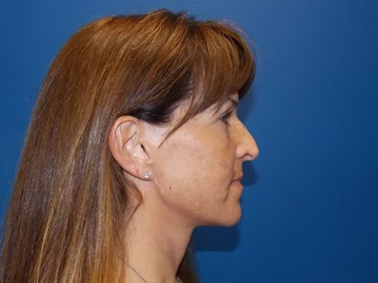 Face & Neck Lift Before & After Patient #3907