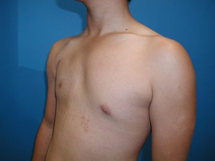 Poland Syndrome Before & After Patient #4018