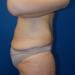 Body Contouring Before & After Patient #3891