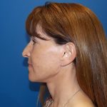 Face & Neck Lift Before & After Patient #3907