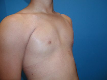 Poland Syndrome Before & After Patient #4018