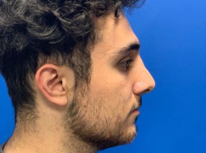Rhinoplasty Before & After Patient #4084