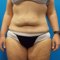 Body Contouring Before & After Patient #3891