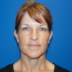 Face & Neck Lift Before & After Patient #3907