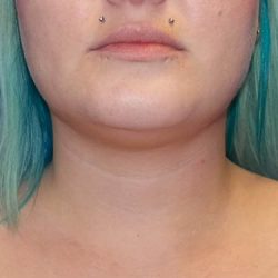 Submental Liposuction Before & After Patient #4066