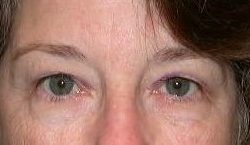 Upper Blepharoplasty Before & After Patient #3880