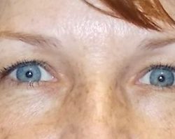 Upper Blepharoplasty Before & After Patient #3900