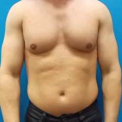 Liposuction Before & After Patient #3914