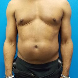 Liposuction Before & After Patient #3933