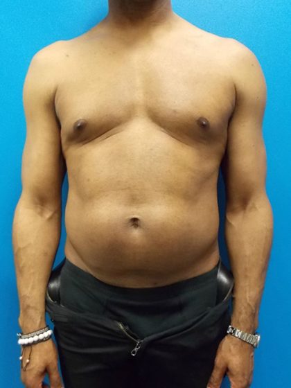 Liposuction Before & After Patient #3933