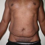 Tummy Tuck Before & After Patient #3984