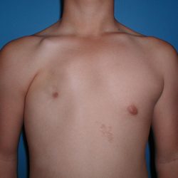 Poland Syndrome Before & After Patient #4018