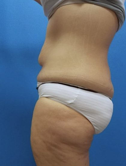 Body Contouring Before & After Patient #3891