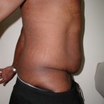 Tummy Tuck Before & After Patient #3984