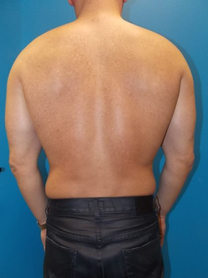 Liposuction Before & After Patient #3914