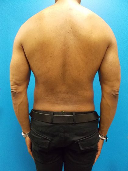 Liposuction Before & After Patient #3933