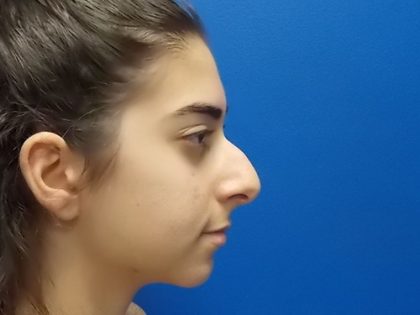Rhinoplasty Before & After Patient #3840